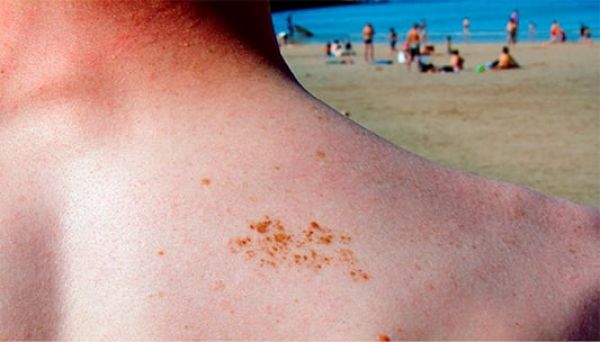 Sol pode causar mutação genética