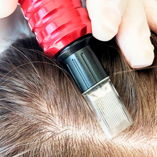 Microinfusão de Medicamentos na Pele – MMP Capilar