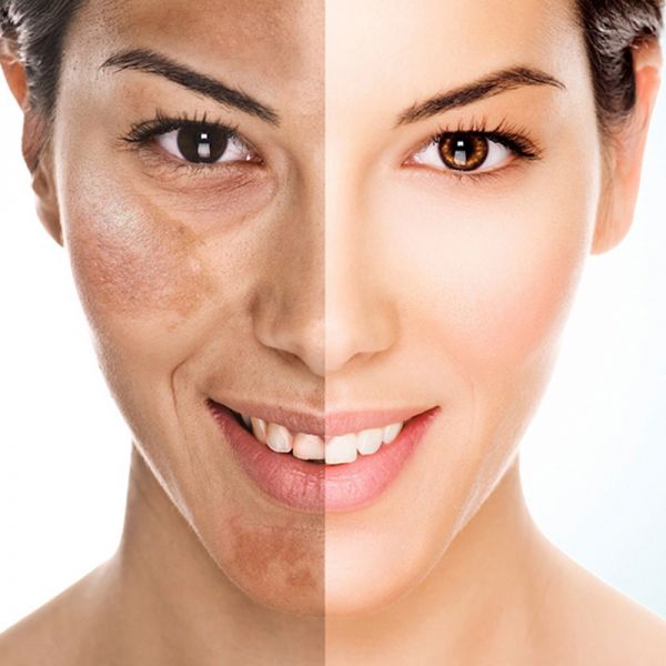 Tratamento de Melasma