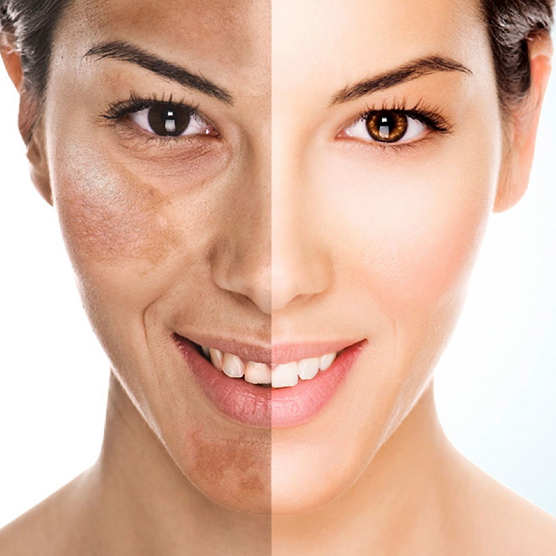 Tratamento de Melasma