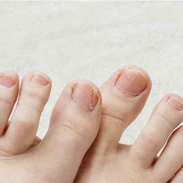 Alterações de Unhas