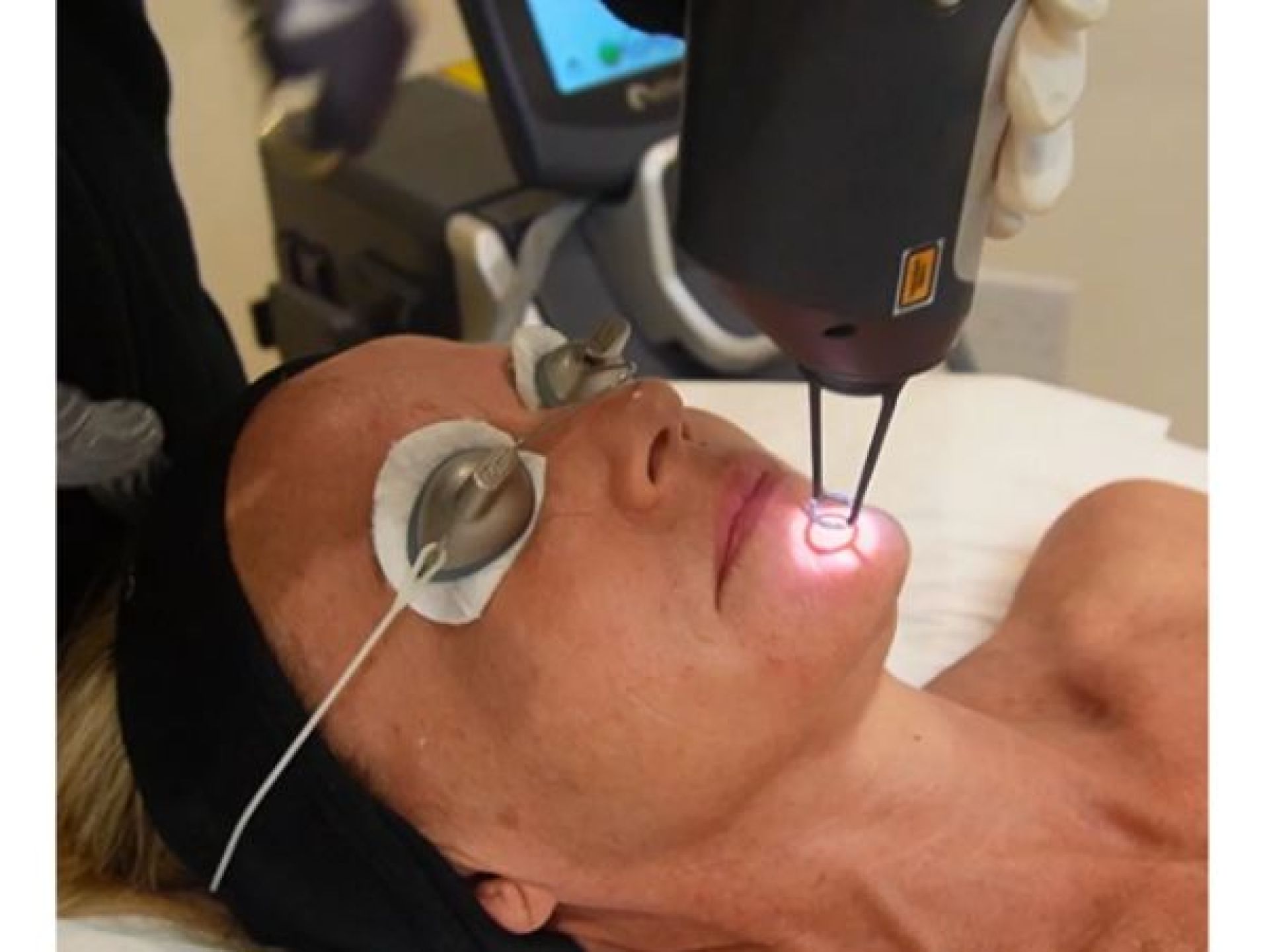 Laser de picossegundos - Handpico